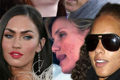 Ποιος είπε πώς οι celebrities δεν έχουν ακμή;