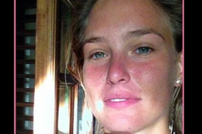 Με έγκαυμα στο πρόσωπο η Bar Refaeli