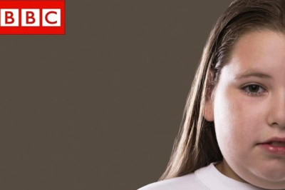 Μετάλλαξη γονιδίου οδηγεί στην παχυσαρκία