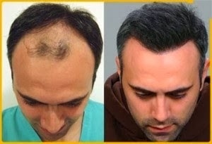 Καράφλα τέλος... τώρα!