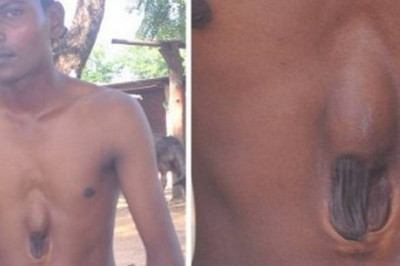 Ιατρικό θαύμα: Ο άνθρωπος που ζει με την καρδιά έξω από το στήθος! (video)