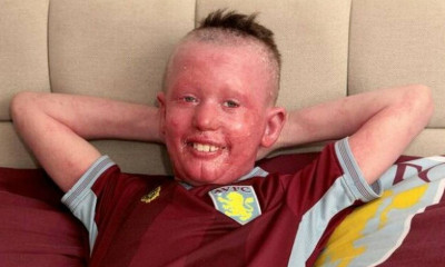 Τον φωνάζουν «Διάβολο» όμως είναι κατακόκκινος από σπάνια αρρώστια (photos+video)