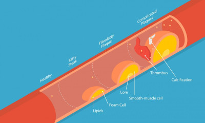 Φραγμένες αρτηρίες: Η διατροφή που μειώνει τον κίνδυνο καρδιαγγειακών