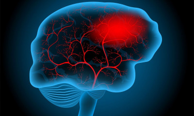 Υπαραχνοειδής αιμορραγία: Τι πρέπει να γνωρίζετε