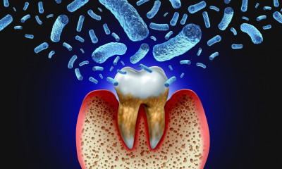 Περιοδοντίτιδα: Πώς συνδέεται με την ατροφία εγκεφάλου