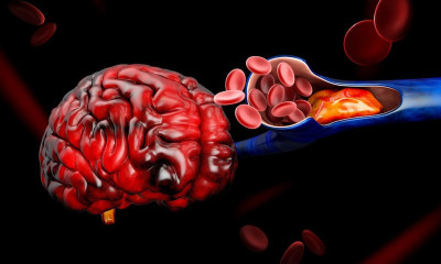 Θρόμβωση: Ποιοι άνθρωποι αντιμετωπίζουν πολλαπλάσιο κίνδυνο