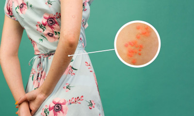 Ψωρίαση: Ποια άλλα όργανα μπορεί να επηρεάσει εκτός από το δέρμα