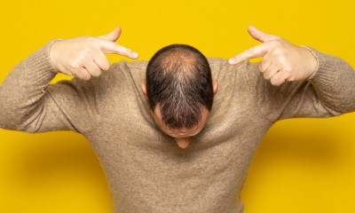 Γυροειδής αλωπεκία: Αιτίες, συμπτώματα και αντιμετώπιση