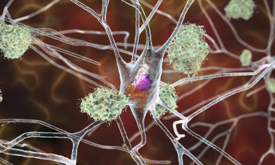 Αλτσχάιμερ: Η ορμόνη που διασπά την πλάκα στον εγκέφαλο