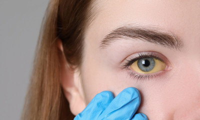 Πρόβλημα στο συκώτι: 5 συμπτώματα που εκδηλώνονται στο πρόσωπο