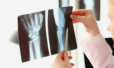 Αρθρίτιδα χεριών: Τι είναι καλύτερο για την αντιμετώπιση του πόνου