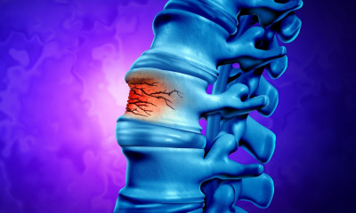 Οστεοπορωτικό κάταγμα: Ποιοι ανήκουν στην κατηγορία υψηλού κινδύνου