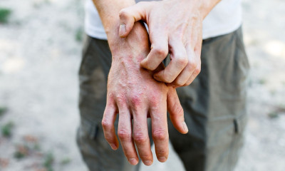 Φαγούρα στα χέρια: Πώς θα καταλάβετε αν είναι έκζεμα