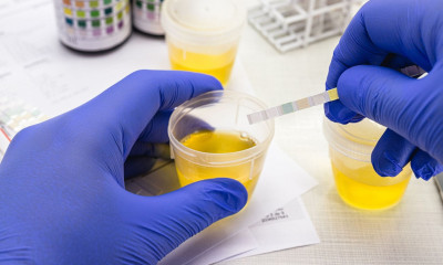 Το τεστ ούρων που εντοπίζει με ακρίβεια 99% δύο τύπους καρκίνου