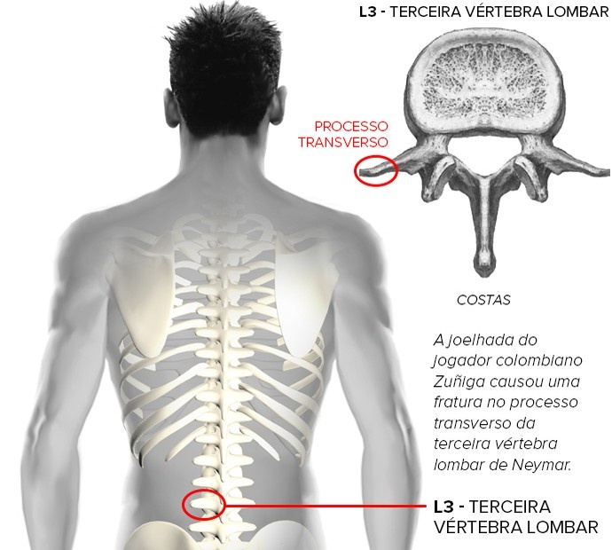 contusao2