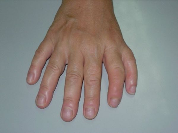 Το ποδόσφαιρo… χέρι άκρας υγείας