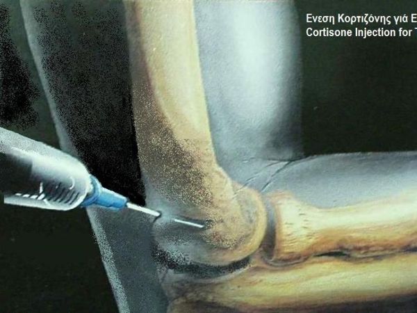Αρθρίτιδα του Αγκώνος