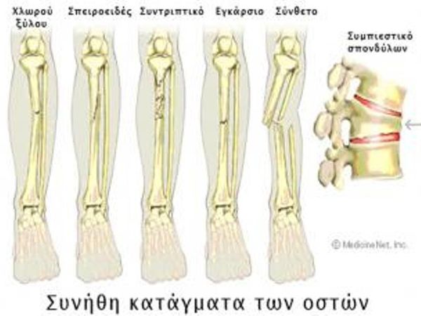 Αντιμετώπιση καταγμάτων
