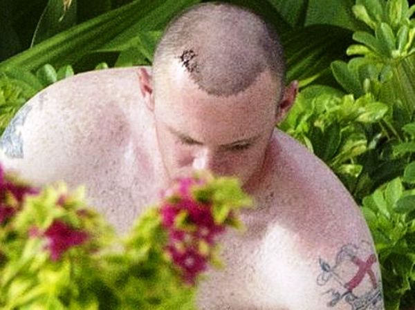 Η ουλή του Ρούνεϊ 