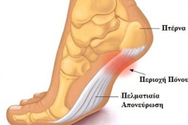 Πόνος στο Πέλμα- Πελματιαία Απονευρωσίτιδα