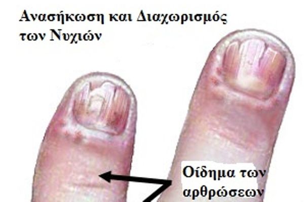 Ψωριασική Αρθρίτιδα