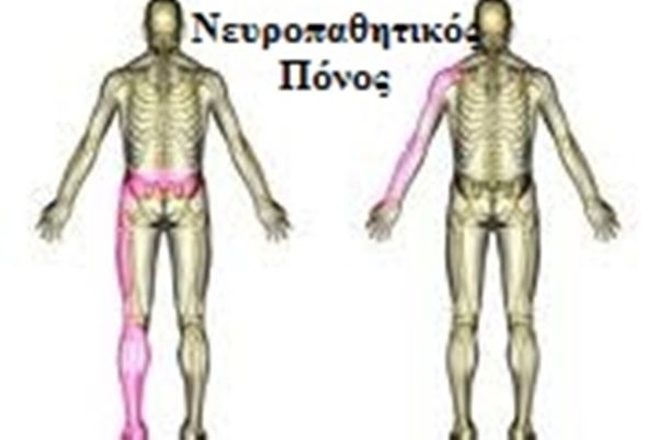 Νευροπαθητικός πόνος