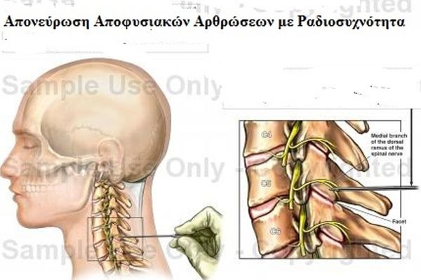 Σύνδρομο Ζυγοαποφυσιακών Αρθρώσεων Αυχένα