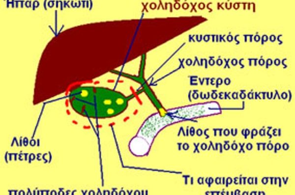 Χολολιθίαση και παθήσεις χοληδόχου κύστεως