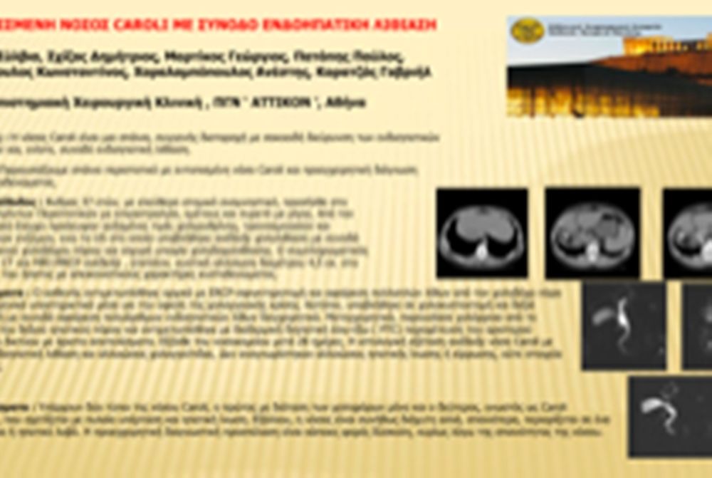  Εντοπισμένη νόσος CAROLI με συνοδό ενδοηπατική λιθίαση