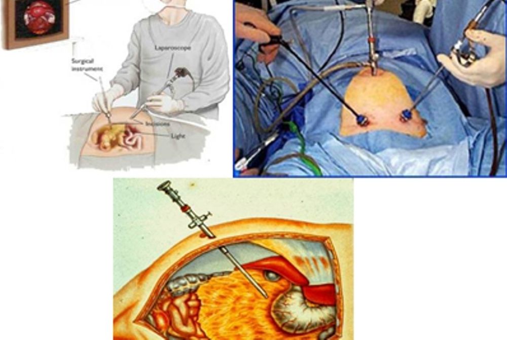  Λαπαροσκόπηση - Λαπαροσκοπική χειρουργική