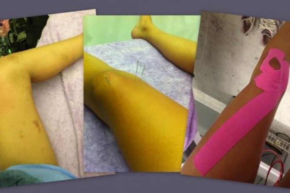 Παίκτρια του DWTS γέμισε μελανιές και κάνει βελονισμό!