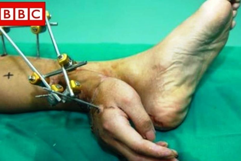 Κίνα: Έραψαν κομμένο χέρι στον αστράγαλο ασθενή για να το σώσουν