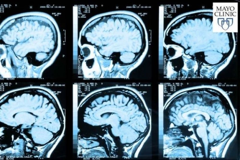 Ανεύρυσμα στον εγκέφαλο: Ποια είναι τα συμπτώματα;