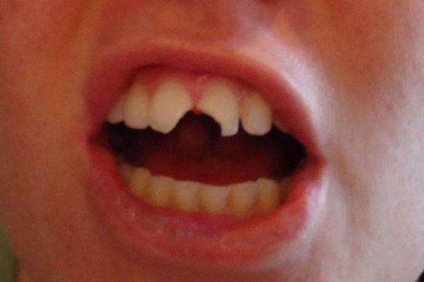Έσπασε το μπροστινό του δόντι γνωστός ΝΒΑερ! (video)