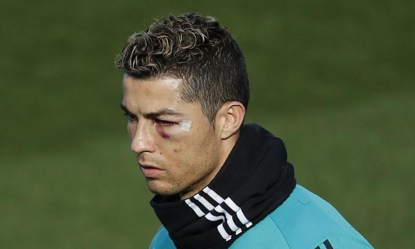 Με «πρησμένο» μάτι στην προπόνηση ο Ρονάλντο! (video)