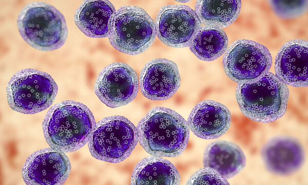 Λέμφωμα Hodgkin και μη-Hodgkin: Αυτά είναι τα ύποπτα συμπτώματα