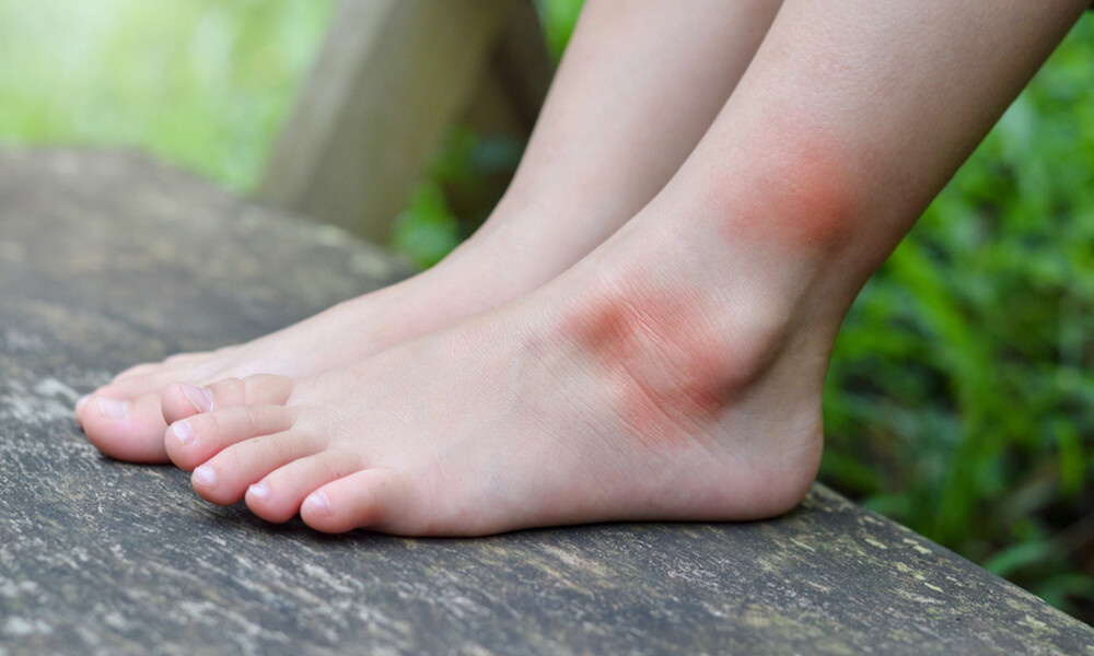 Αλλεργία στο τσίμπημα κουνουπιού: Τα ανησυχητικά συμπτώματα (εικόνες)