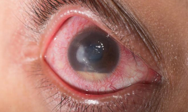 Γλαύκωμα: Τα στοιχεία που αντιμετωπίζουν τα συμπτώματα (εικόνες)