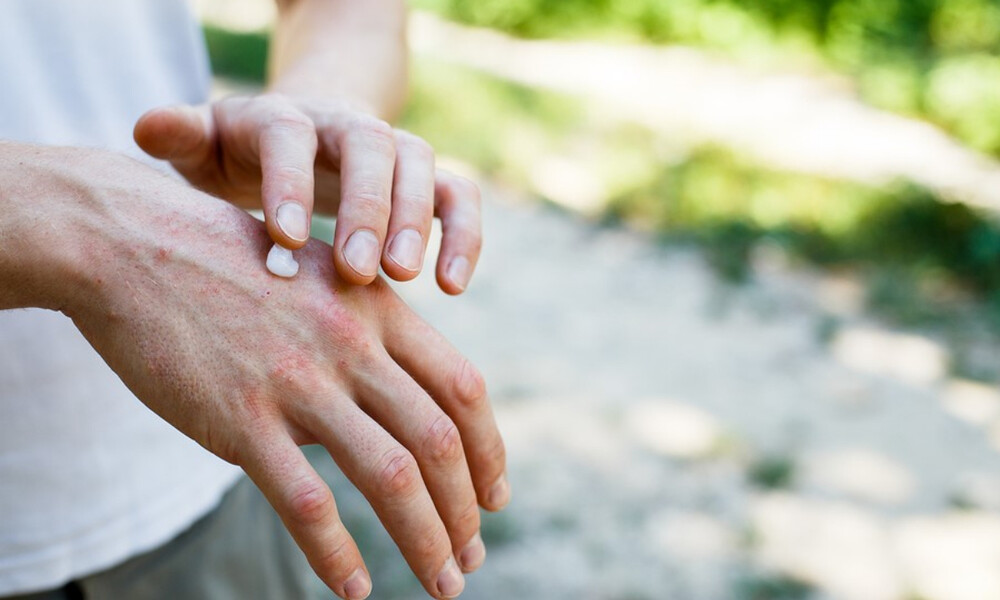 Ξηρή επιδερμίδα το καλοκαίρι: Πώς θα την αντιμετωπίσετε (εικόνες)