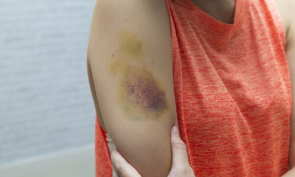 Μελανιάζετε εύκολα; Δείτε τις πιθανές αιτίες (εικόνες)