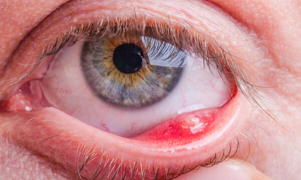 Κριθαράκι στο μάτι: 9 εύκολοι τρόποι για να υποχωρήσει (εικόνες)