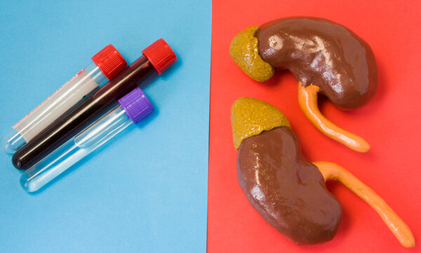 Αυξημένη κρεατινίνη: 6 τρόποι για να την μειώσετε (εικόνες)