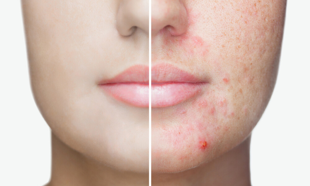Ακμή ενηλίκων: 7 θρεπτικά στοιχεία για να την αντιμετωπίσετε (εικόνες)