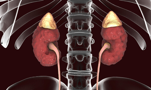 Οξεία πυελονεφρίτιδα: 7 συμπτώματα που δεν πρέπει να αγνοήσετε (εικόνες)
