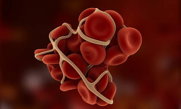 Θρόμβος στο πόδι: 5 τροφές που προλαμβάνουν τον σχηματισμό (εικόνες)