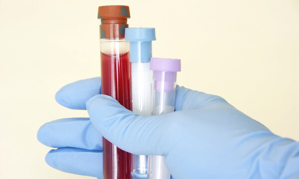 Αυξημένα λεμφοκύτταρα (λεμφοκυττάρωση): 7 αιτίες σε εικόνες