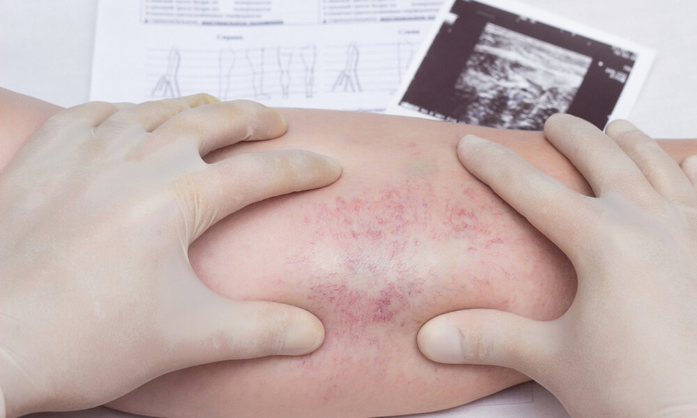 Θρομβοφλεβίτιδα: Οι βασικοί παράγοντες κινδύνου της απειλητικής κατάστασης (εικόνες)