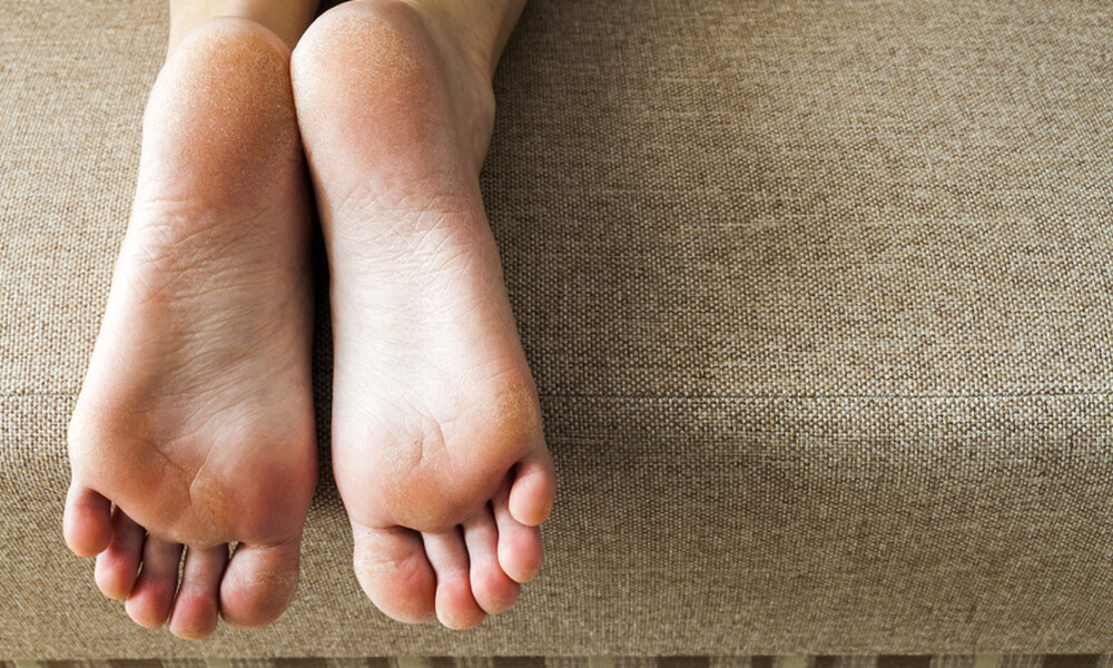 4 δερματικές παθήσεις των ποδιών και τα συμπτώματά τους (εικόνες)