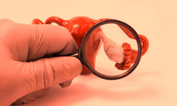 Καρκίνος ωοθηκών: 8 πρώιμα συμπτώματα του θανατηφόρου γυναικολογικού καρκίνου (εικόνες)