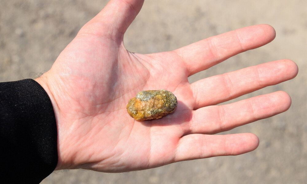 Πέτρες στη χολή: 5 σημάδια που στέλνει το σώμα (εικόνες)